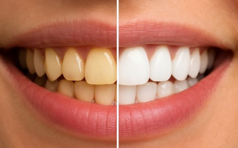 Diş Beyazlatma İşlemi Dişe Zarar Vermiyor